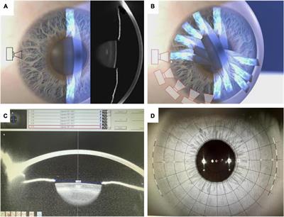 Kinetic pupillary size using Pentacam in myopia